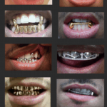 types and styles of grillz