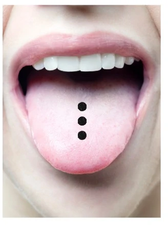 Multiple tongue piercing