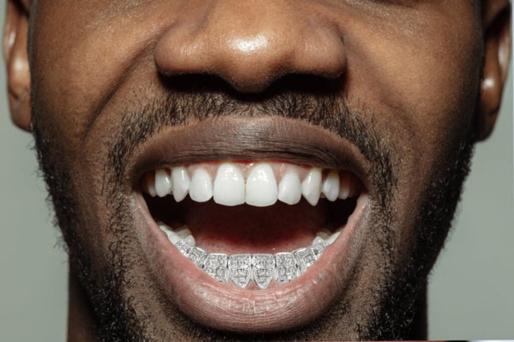 What Are Grillz? The HipHop Fashion Trend That’s on the Rise